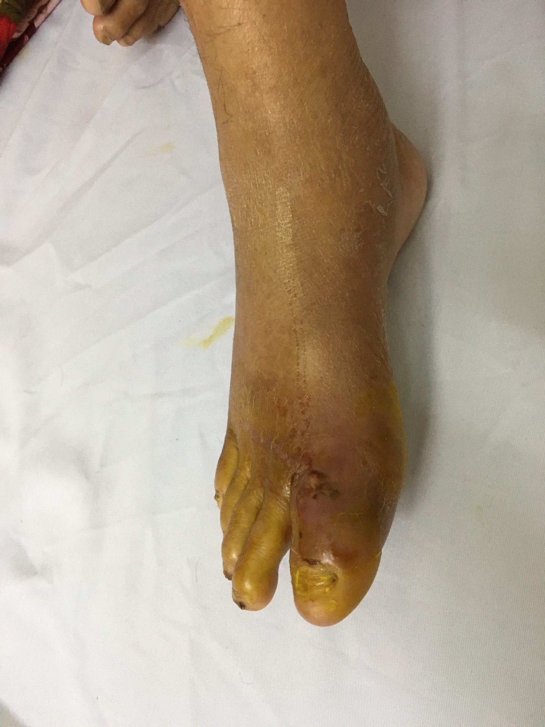 Hình ảnh biến chứng bàn chân ở bệnh nhân tiểu đường